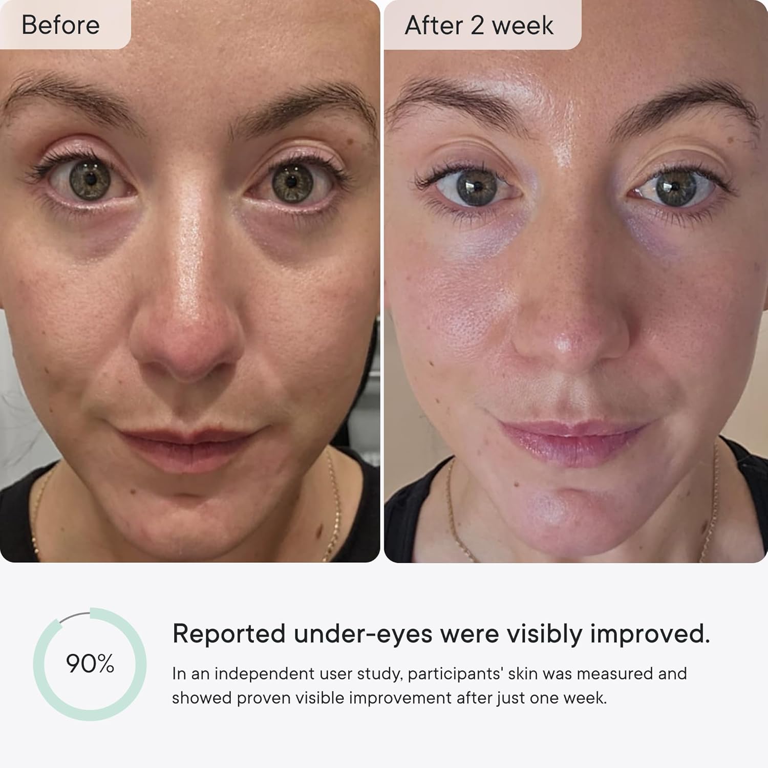 Micro-Infusion anti Wrinkle Patches for Smile Line, Frown Lines, under Eye Bags, Puffiness, Crow'S Feet - Retinol, Caffeine - Dissolvable for Overnight Use - 8 Pairs